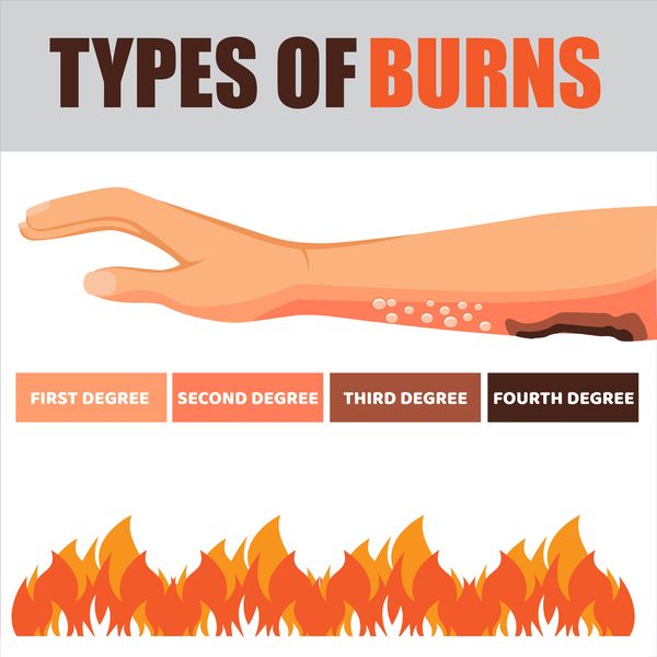 Infographic of the different degrees of burns one could sustain.